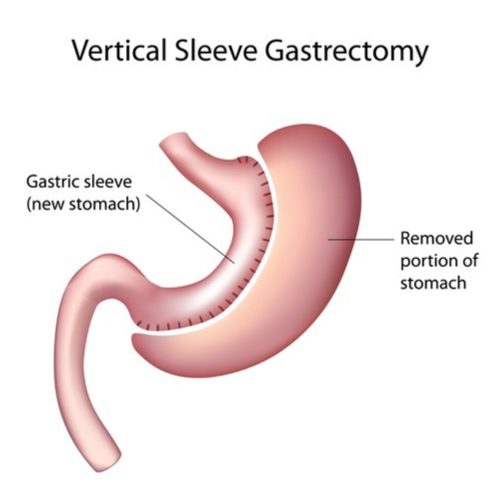 Gastrectomie longitudinale - sleeve - gastrectomie en manchon - chirurgie bariatrique restrictive