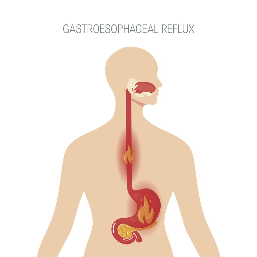 Reflux gastro-oesophagien : une complication fréquente de la sleeve