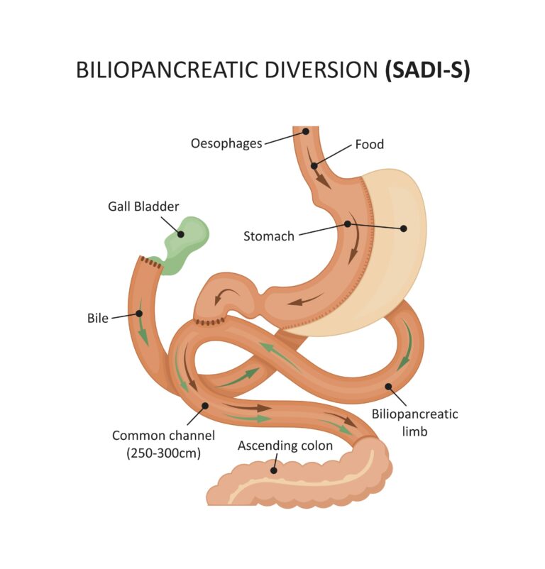 SADI-S et SASI By Pass : les avantages de la sleeve associée à une malabsorption