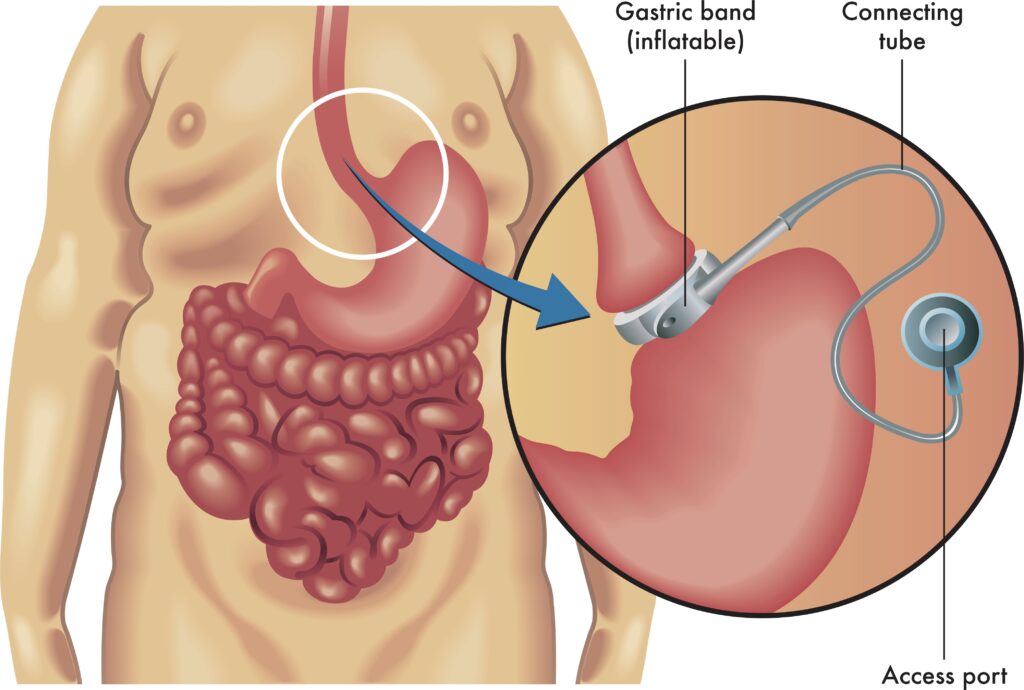 LASGB - Anneau gastrique par laparoscopie - Laparoscopic Adjustable Silicone Gastric banding - Chirurgie bariatrique restrictive