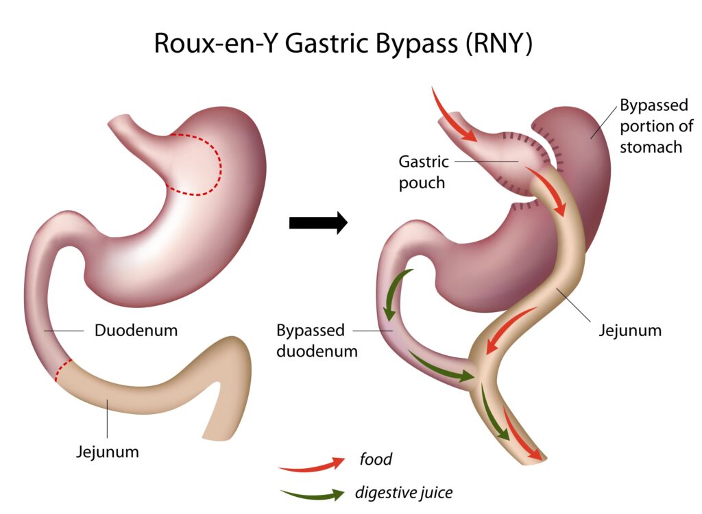 By-pass gastrique - bypass gastro-jejunal - chirurgie bariatrique de malabsorption