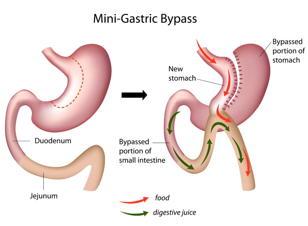 Mini gastric by-pass - mini by-pass - chirurgie bariatrique de malabsorption