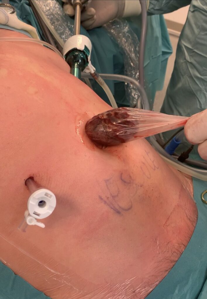 Extraction de la vésicule par l'incision au dessus du nombril à la fin d'une cholécystectomie par laparoscopie au CHR de Huy