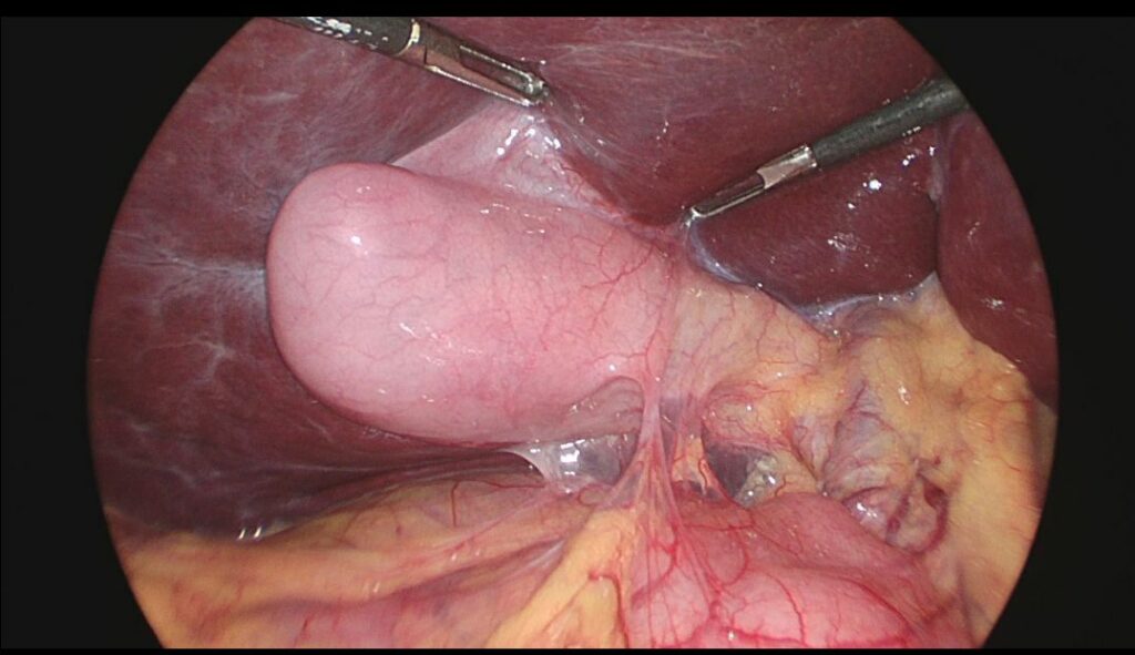Vue d'une cholécystectomie par laparoscopie au CHR de Huy