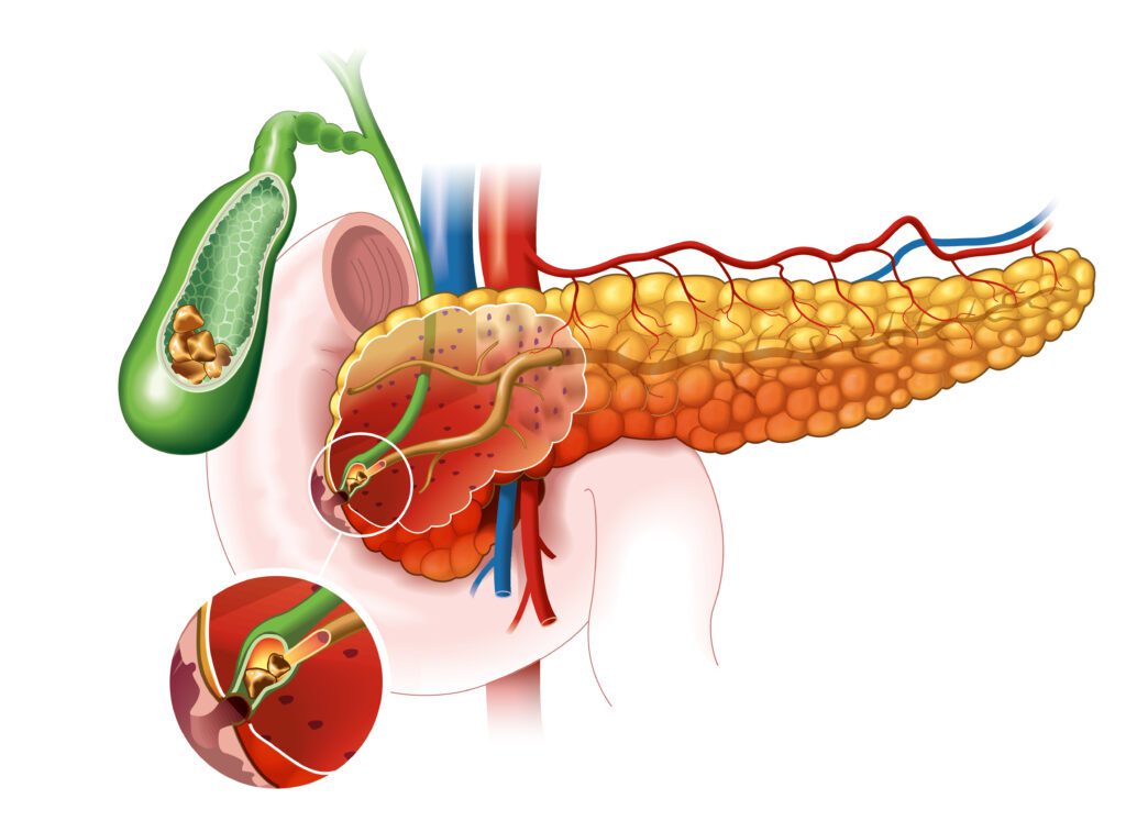 Pancréatite biliaire par obstruction de la papille : une complication fréquente d'une maladie banale de la vésicule biliaire.