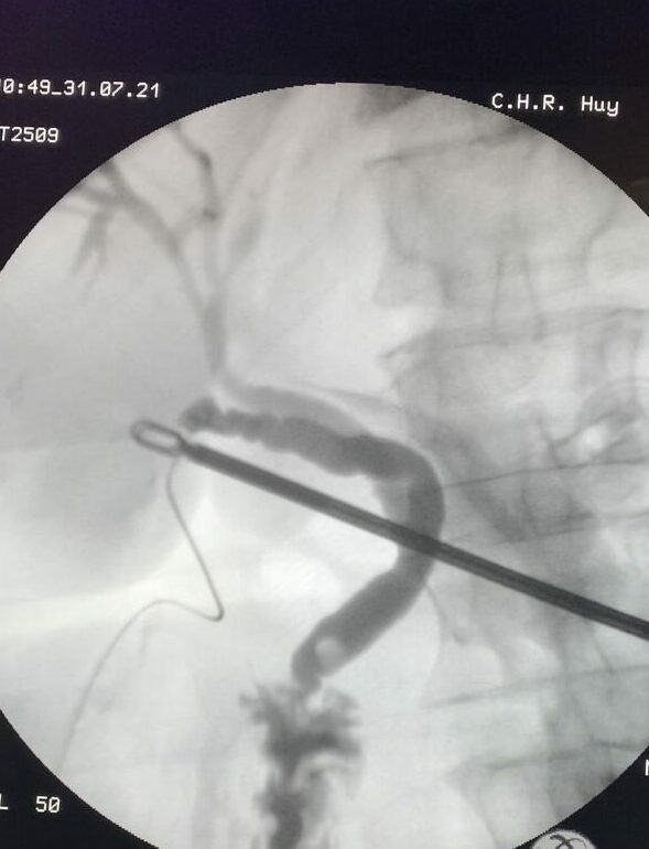 Image de cholangiographie peropératoire en cours de cholécystectomie par laparoscopie au CHR de Huy + lithiase du cholédoque