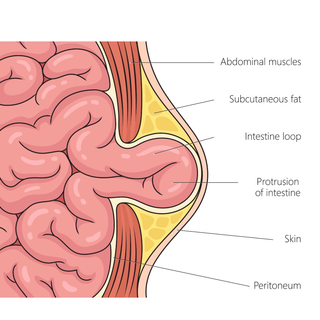 Anatomie d'une hernie de la paroi abdominale