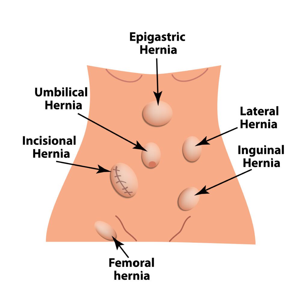 Les différents types de hernies de la paroi abdominale antérieure.