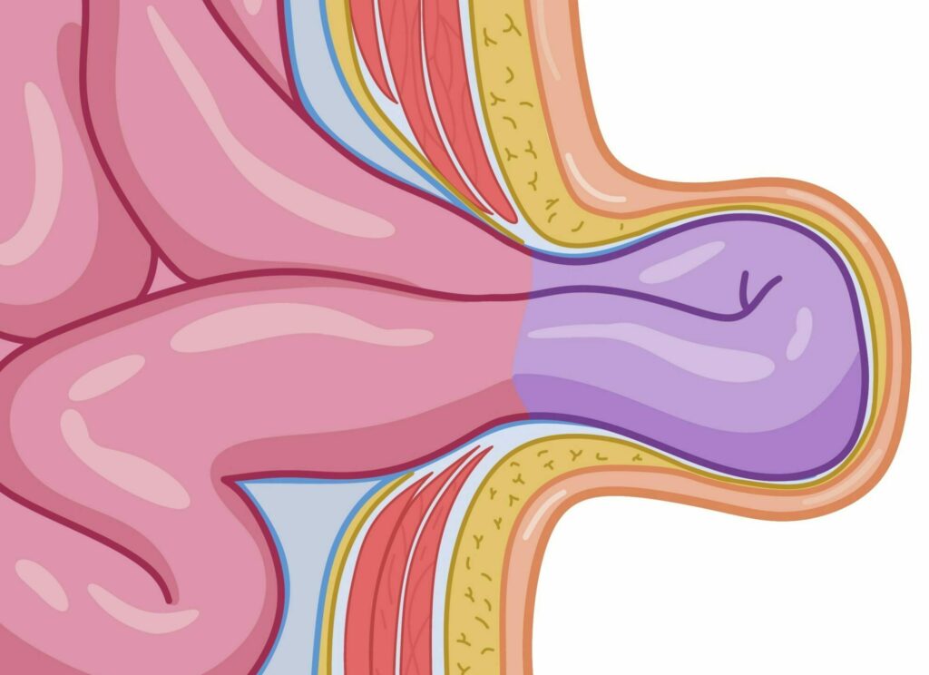 Hernie étranglée avec souffrance intestinale